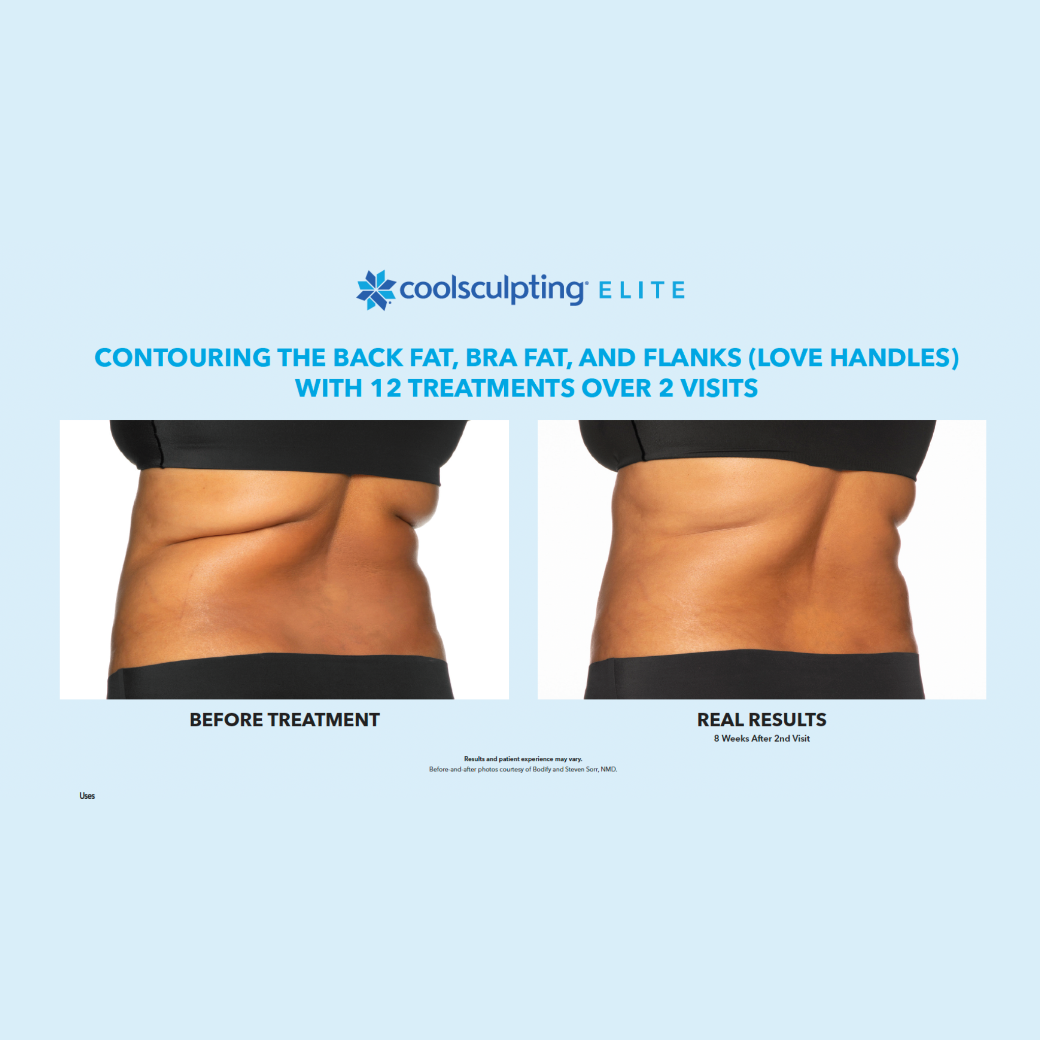 Coolsculpting Mankato